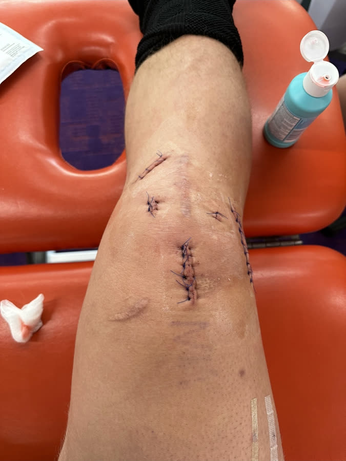 Matthew's knee after his 3rd ACL surgery